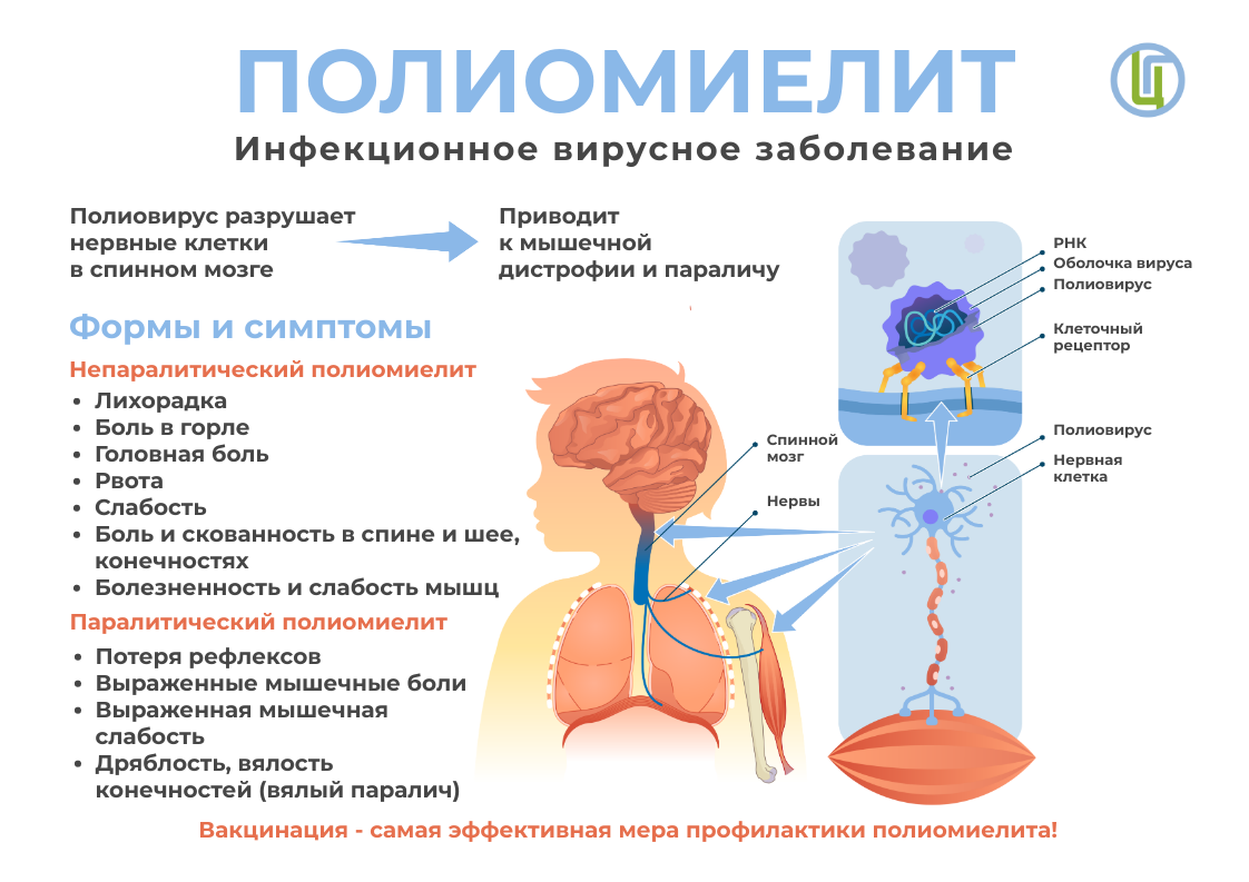 Полиомиелит - инфекционное вирусное заболевание.